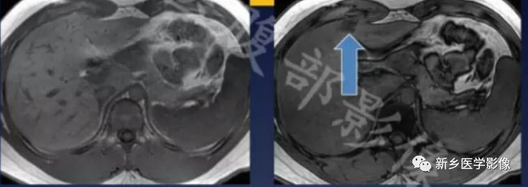 脂肪肝,大学问,看磁共振分析 脂肪肝,大学问,看磁共振分析