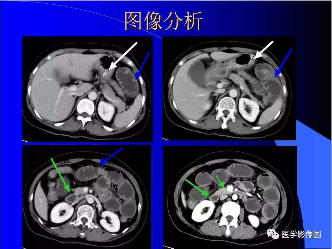 【病例】小肠粪石梗阻1例CT影像表现