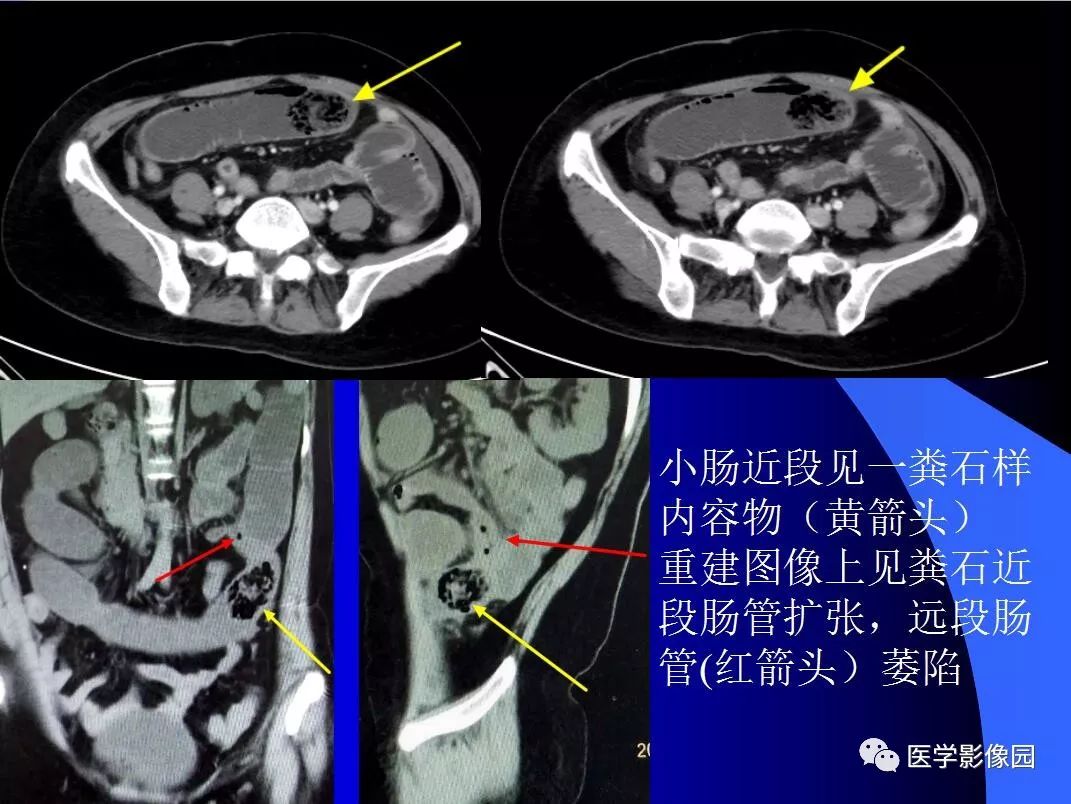 【病例】小肠粪石梗阻1例CT影像表现