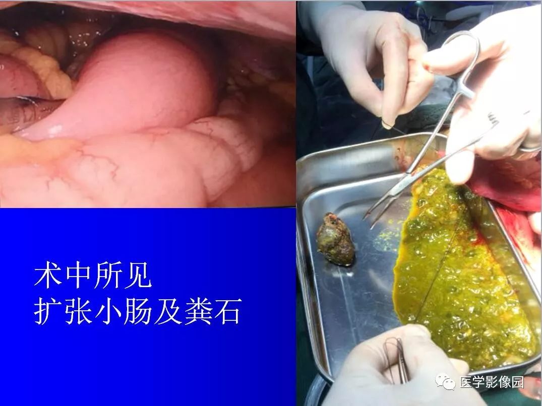 【病例】小肠粪石梗阻1例CT影像表现