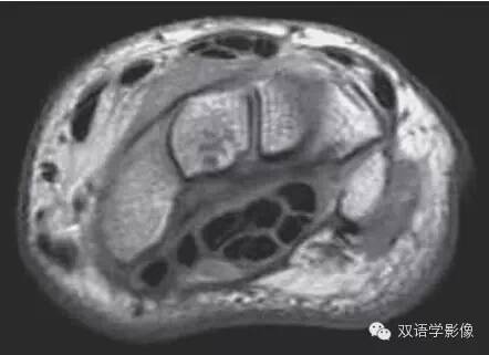 【双语病例】Carpal Tunnel Syndrome腕管综合征 【双语病例】Carpal Tunnel Syndrome腕管综合征