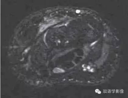 【双语病例】Carpal Tunnel Syndrome腕管综合征