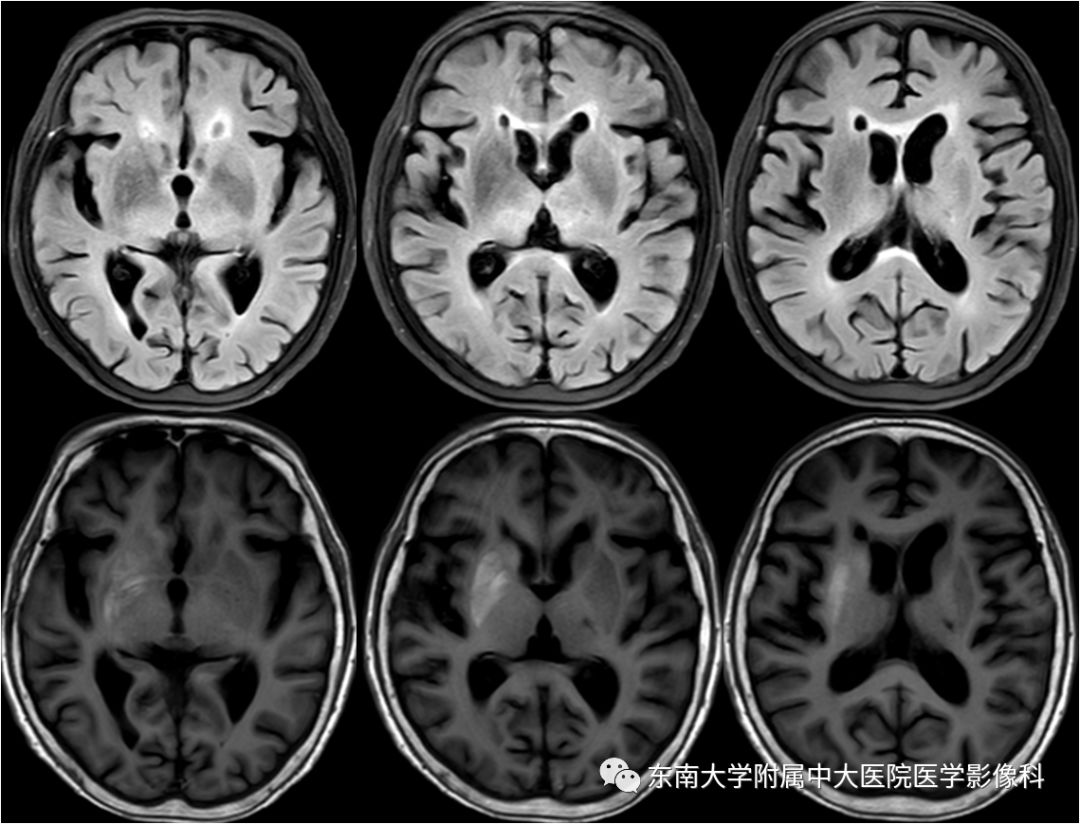 【病例】糖尿病非酮症高渗高血糖状态脑内表现1例CT及MR影像表现