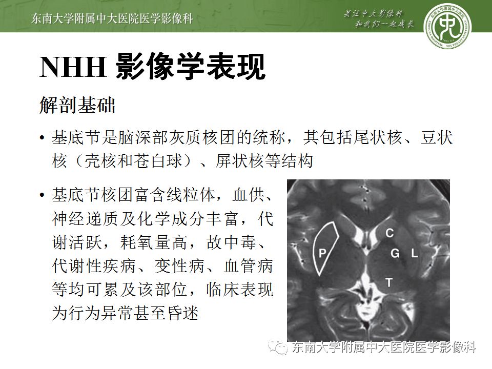 【病例】糖尿病非酮症高渗高血糖状态脑内表现1例CT及MR影像表现