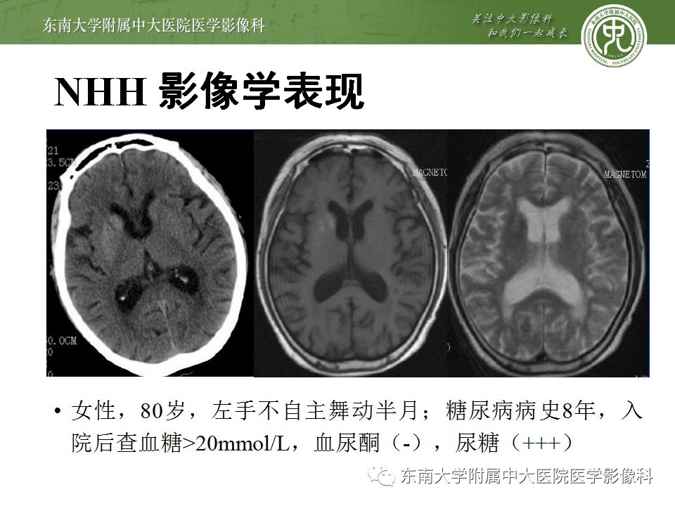【病例】糖尿病非酮症高渗高血糖状态脑内表现1例CT及MR影像表现