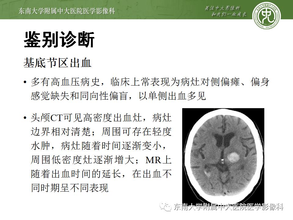 【病例】糖尿病非酮症高渗高血糖状态脑内表现1例CT及MR影像表现