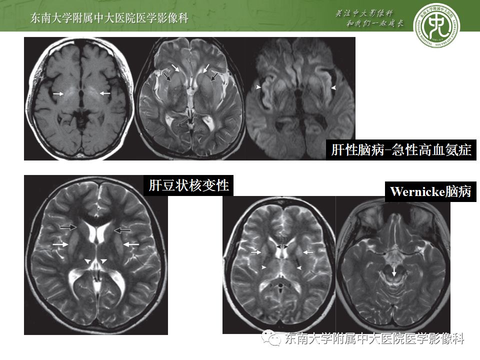 【病例】糖尿病非酮症高渗高血糖状态脑内表现1例CT及MR影像表现