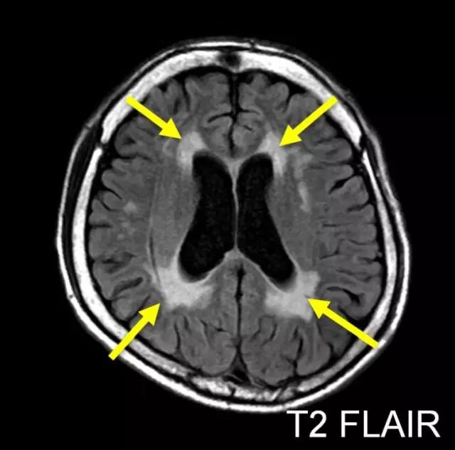 【病例】强直性肌营养不良1型1例MR影像表现 【病例】强直性肌营养不良1型1例MR影像表现