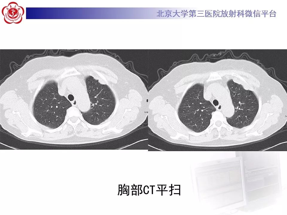 【病例】恶性胸膜间皮瘤1例CT影像诊断