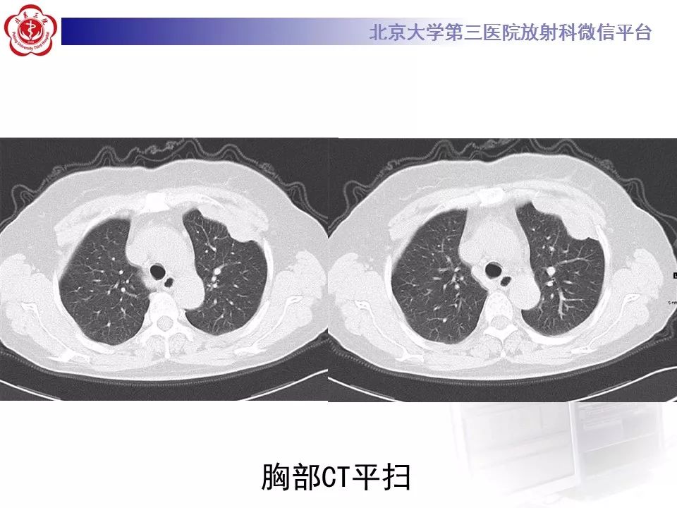 【病例】恶性胸膜间皮瘤1例CT影像诊断