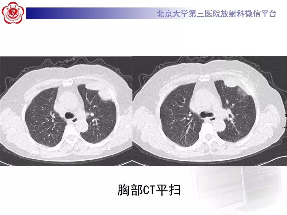 【病例】恶性胸膜间皮瘤1例CT影像诊断