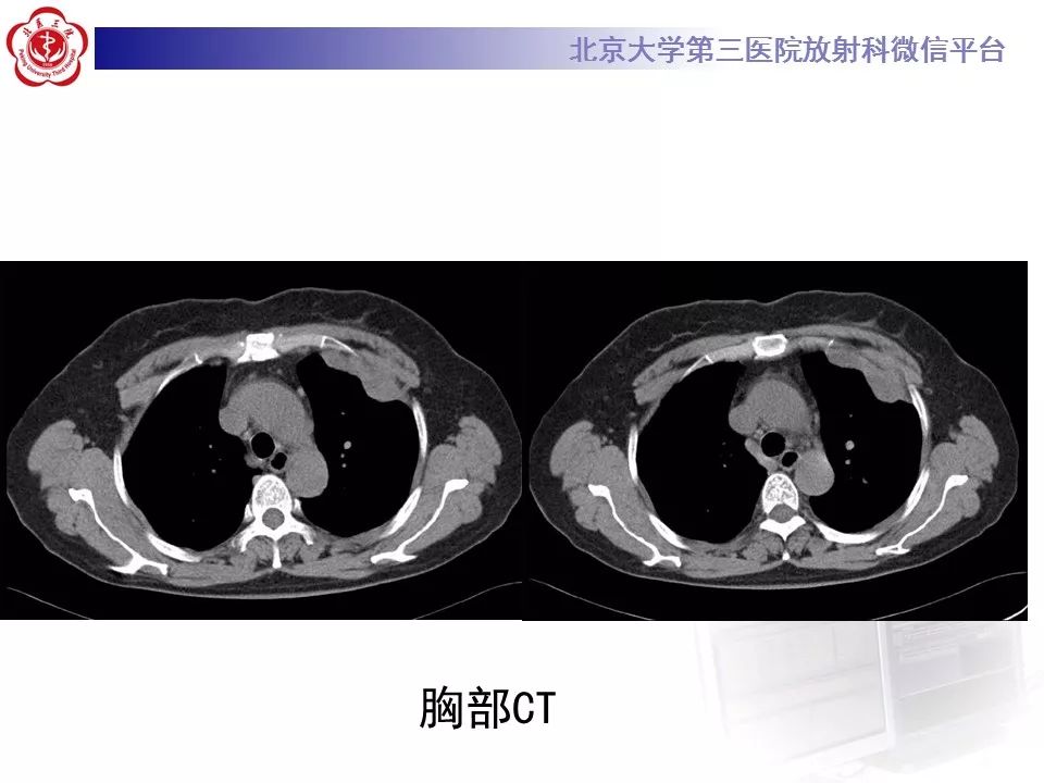【病例】恶性胸膜间皮瘤1例CT影像诊断