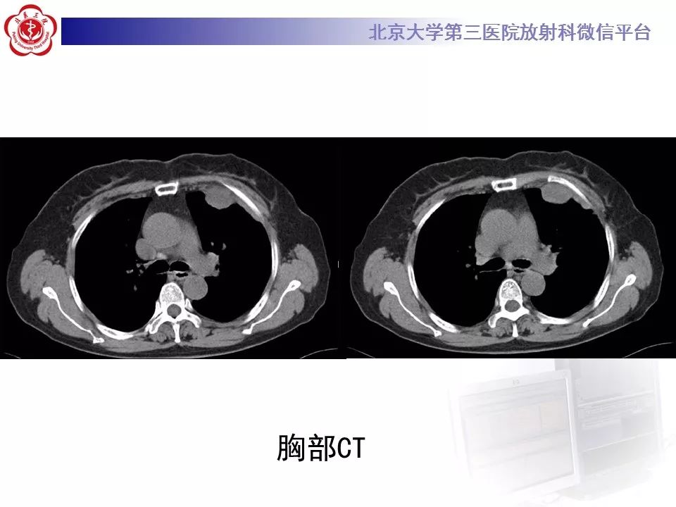 【病例】恶性胸膜间皮瘤1例CT影像诊断