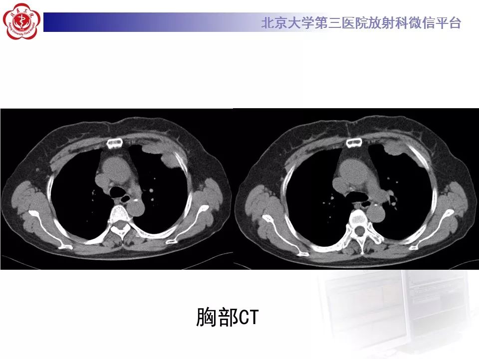 【病例】恶性胸膜间皮瘤1例CT影像诊断