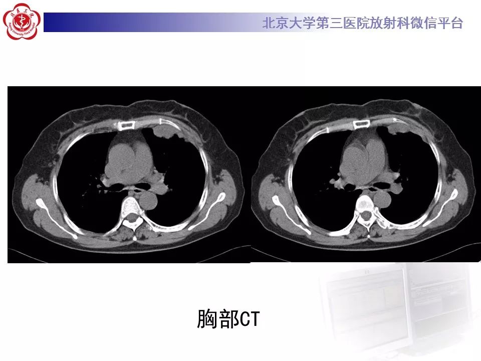 【病例】恶性胸膜间皮瘤1例CT影像诊断