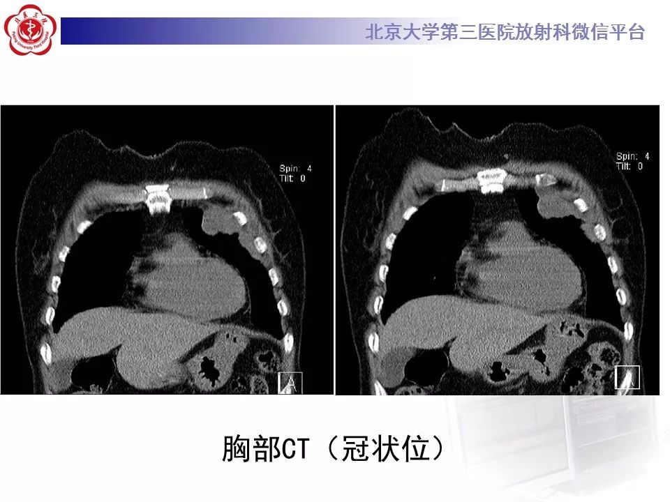 【病例】恶性胸膜间皮瘤1例CT影像诊断