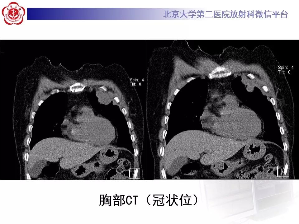 【病例】恶性胸膜间皮瘤1例CT影像诊断