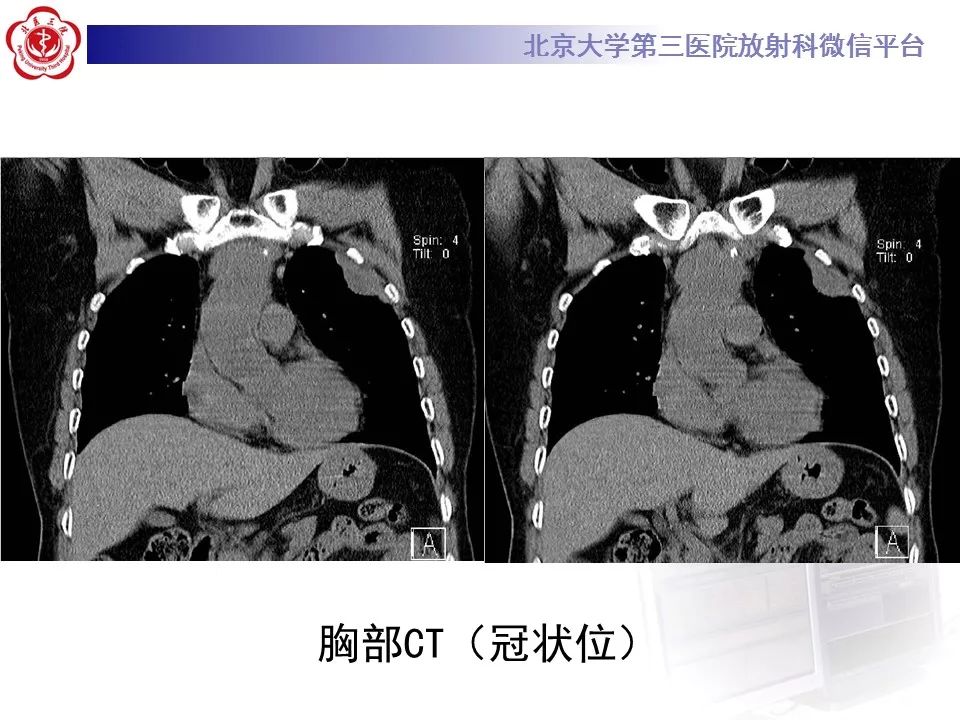 【病例】恶性胸膜间皮瘤1例CT影像诊断