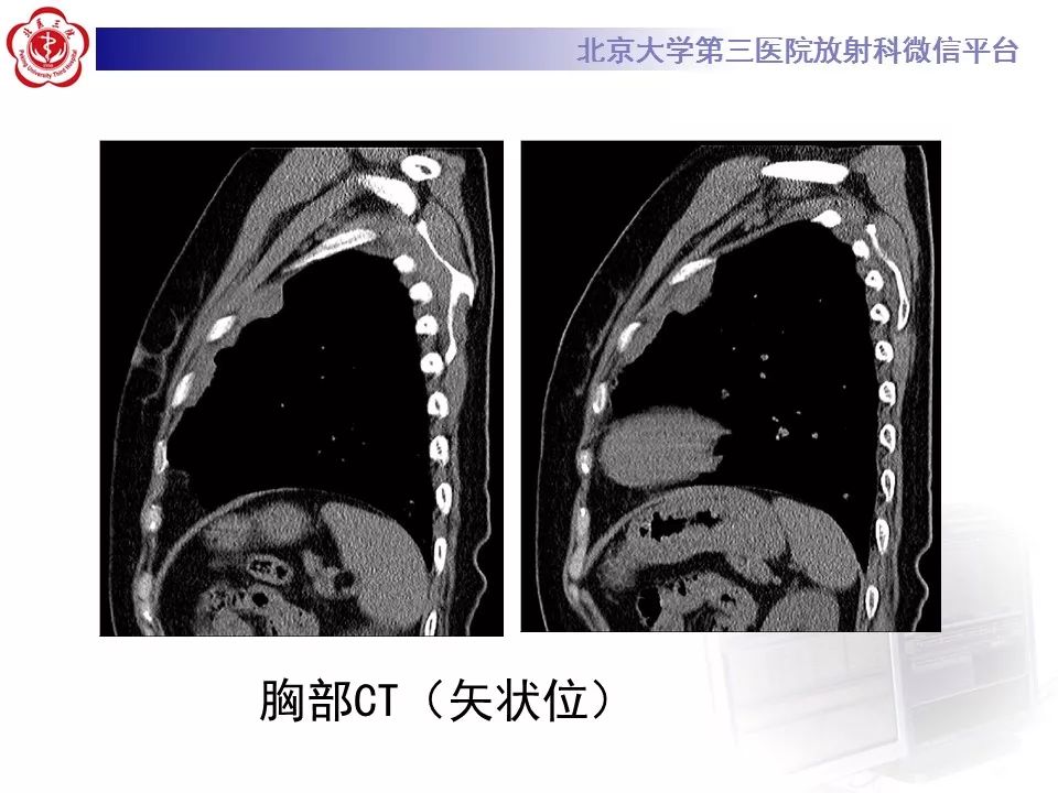 【病例】恶性胸膜间皮瘤1例CT影像诊断