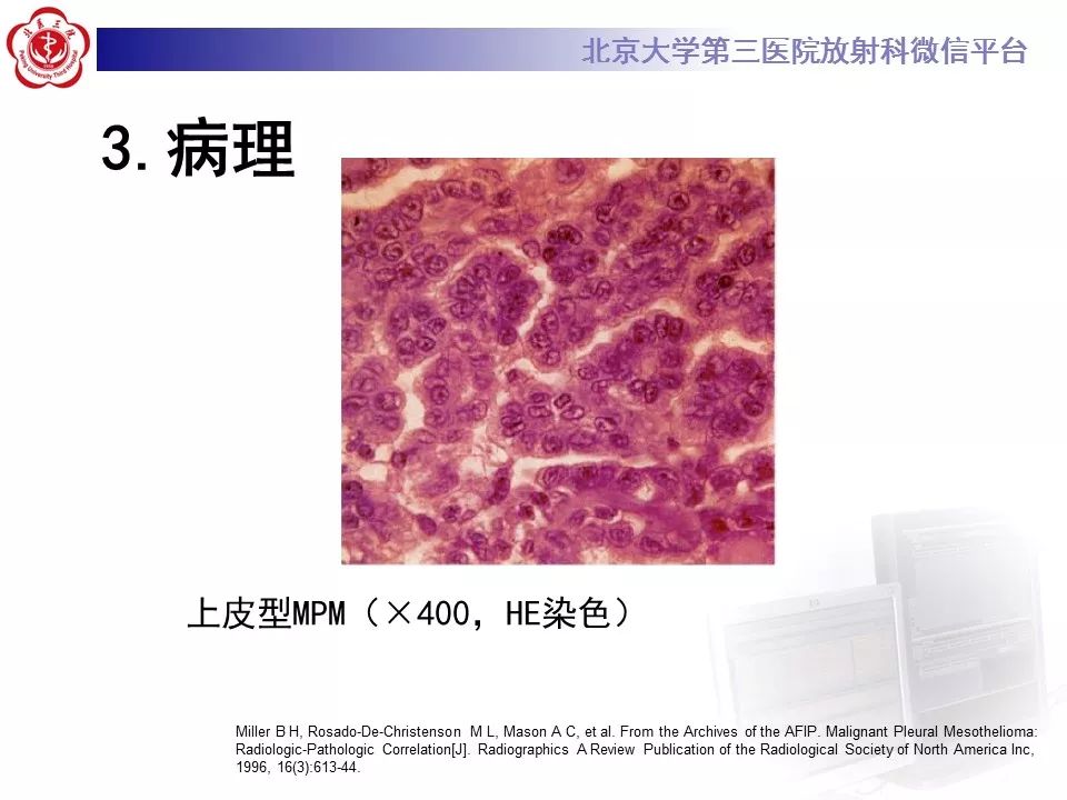 【病例】恶性胸膜间皮瘤1例CT影像诊断