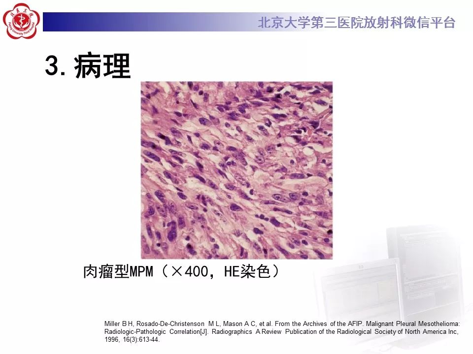 【病例】恶性胸膜间皮瘤1例CT影像诊断