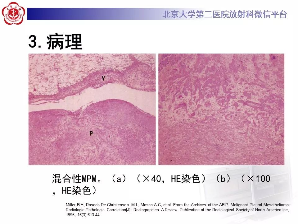 【病例】恶性胸膜间皮瘤1例CT影像诊断