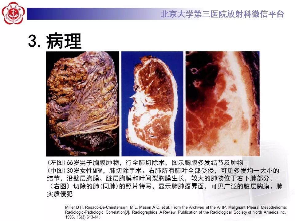 【病例】恶性胸膜间皮瘤1例CT影像诊断