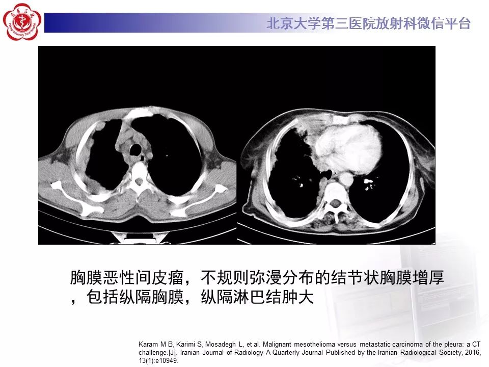 【病例】恶性胸膜间皮瘤1例CT影像诊断