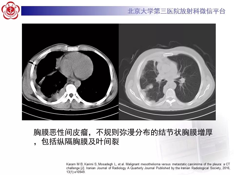 【病例】恶性胸膜间皮瘤1例CT影像诊断