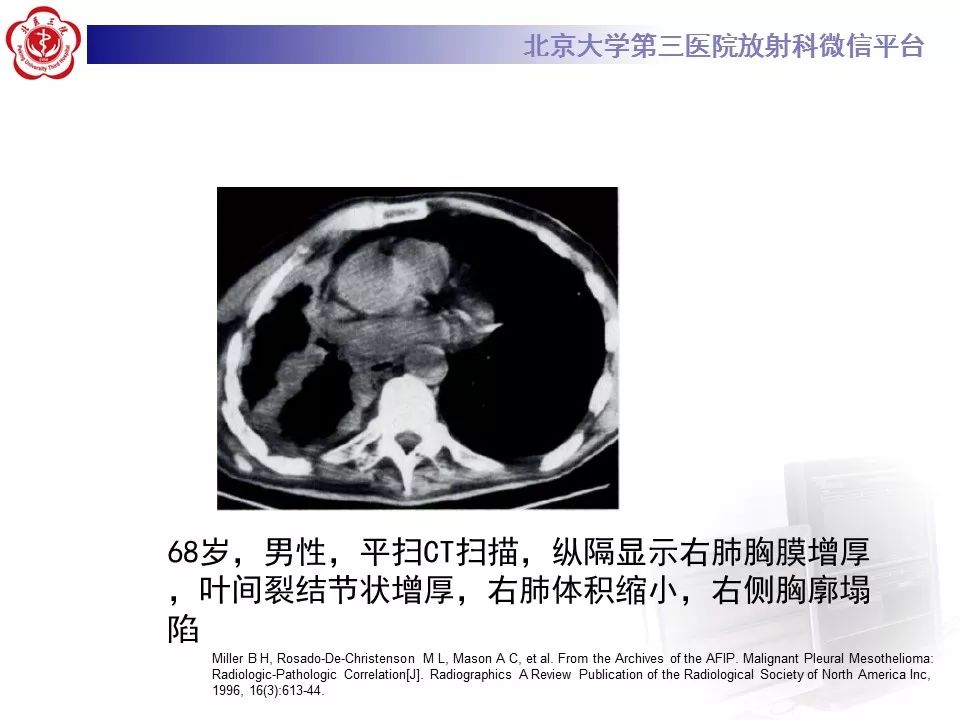 【病例】恶性胸膜间皮瘤1例CT影像诊断