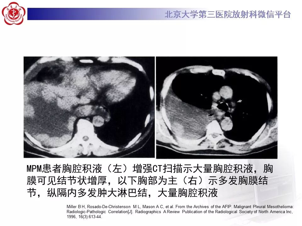 【病例】恶性胸膜间皮瘤1例CT影像诊断
