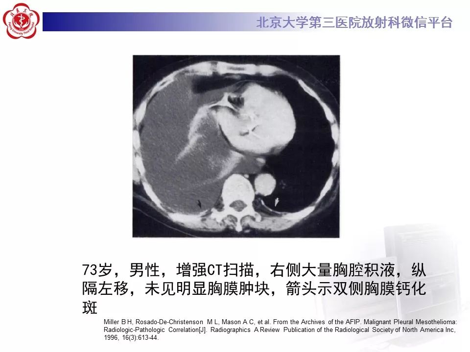 【病例】恶性胸膜间皮瘤1例CT影像诊断