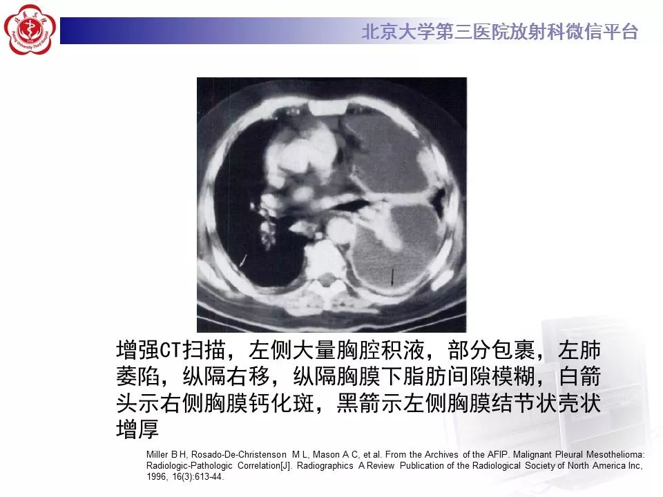 【病例】恶性胸膜间皮瘤1例CT影像诊断