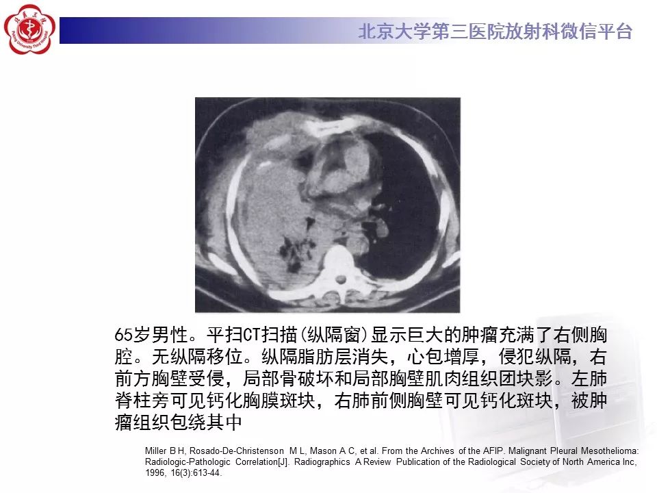【病例】恶性胸膜间皮瘤1例CT影像诊断