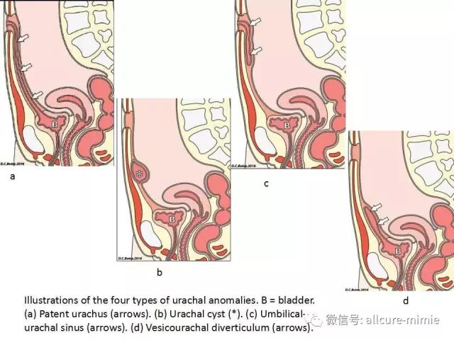 【PPT】正常脐尿管及脐尿管病变的影像学表现