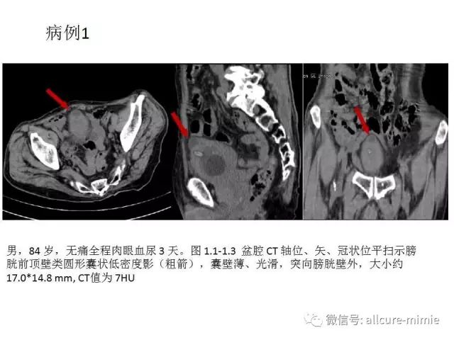 【PPT】正常脐尿管及脐尿管病变的影像学表现