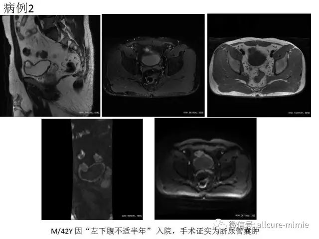 【PPT】正常脐尿管及脐尿管病变的影像学表现