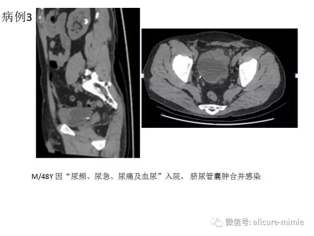 【PPT】正常脐尿管及脐尿管病变的影像学表现