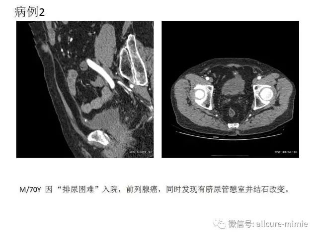 【PPT】正常脐尿管及脐尿管病变的影像学表现