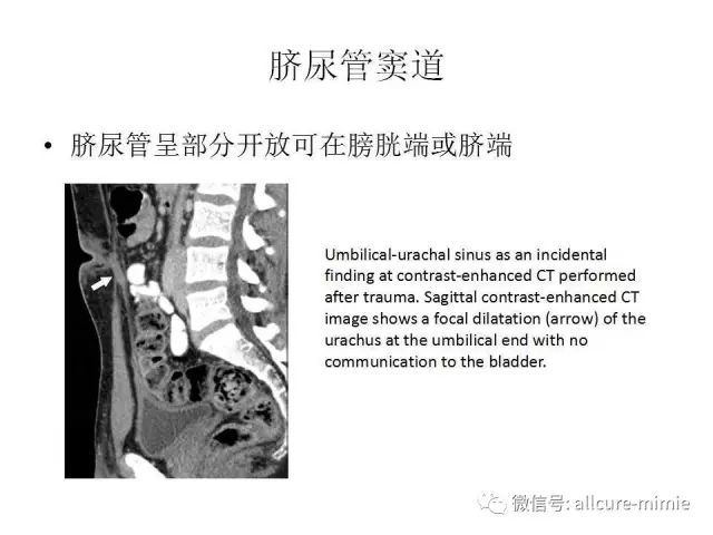 【PPT】正常脐尿管及脐尿管病变的影像学表现