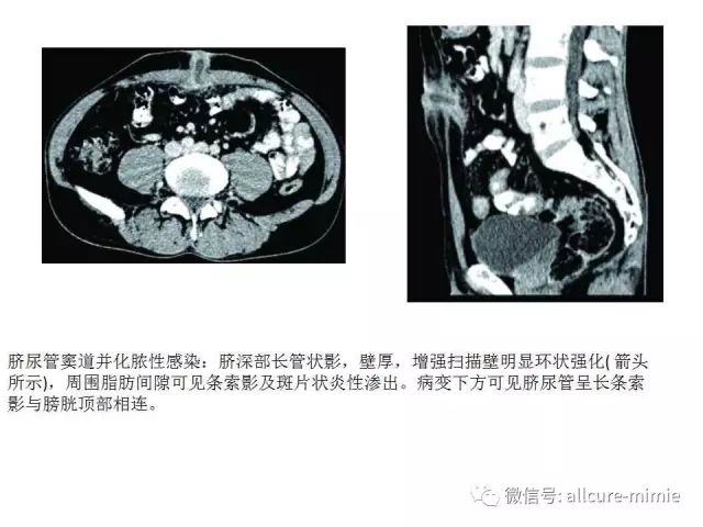 【PPT】正常脐尿管及脐尿管病变的影像学表现