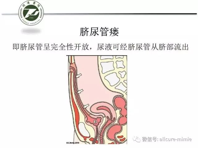 【PPT】正常脐尿管及脐尿管病变的影像学表现