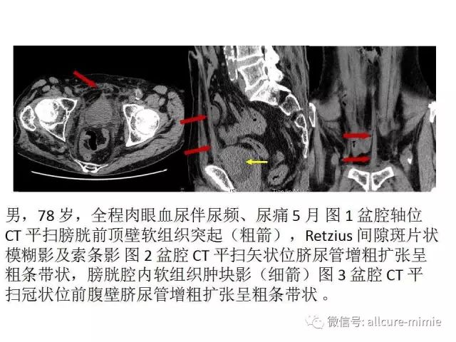【PPT】正常脐尿管及脐尿管病变的影像学表现