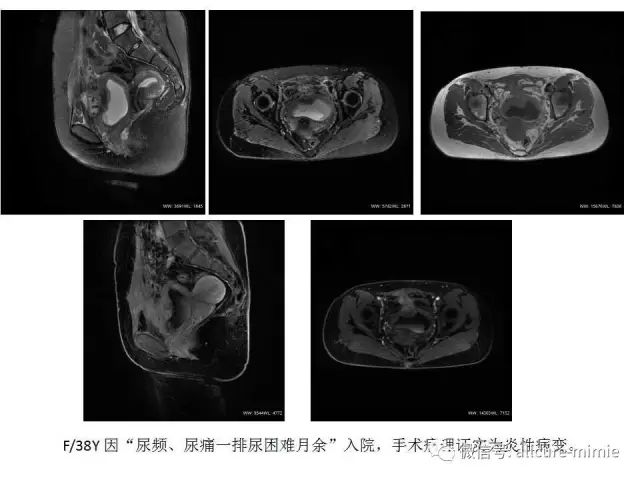 【PPT】正常脐尿管及脐尿管病变的影像学表现