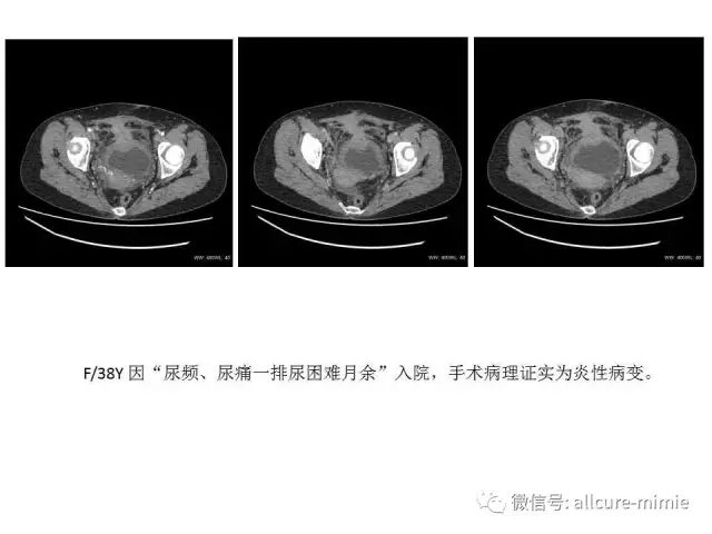 【PPT】正常脐尿管及脐尿管病变的影像学表现