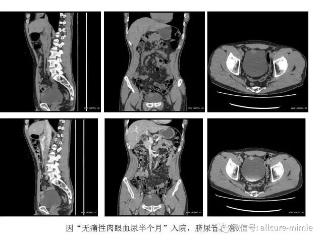 【PPT】正常脐尿管及脐尿管病变的影像学表现