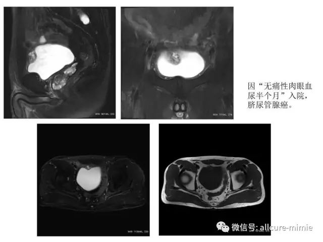 【PPT】正常脐尿管及脐尿管病变的影像学表现