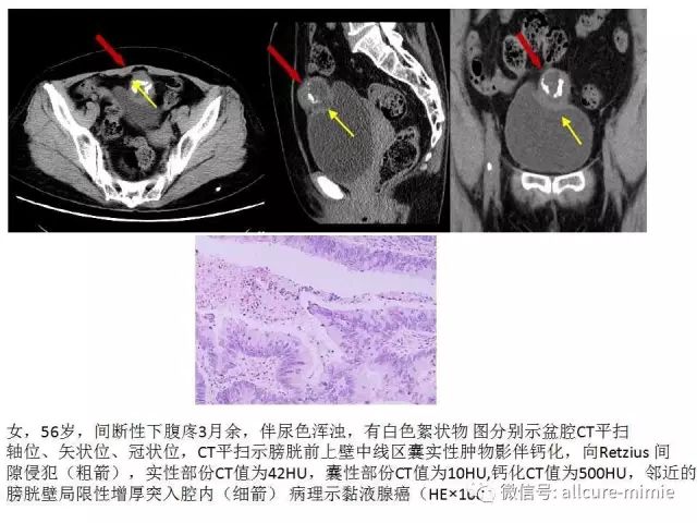 【PPT】正常脐尿管及脐尿管病变的影像学表现