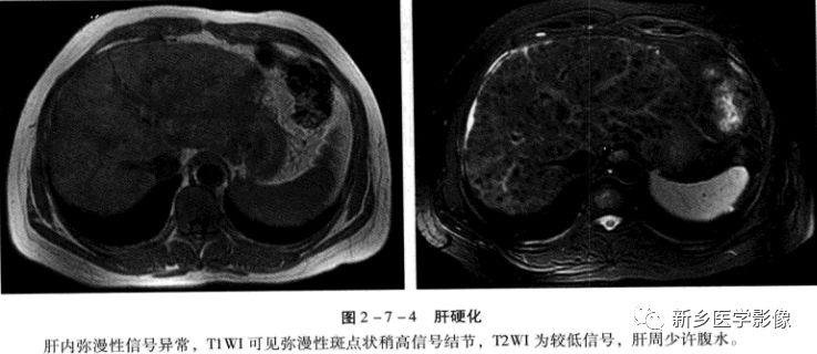 肝硬化磁共振影像表现 肝硬化磁共振影像表现