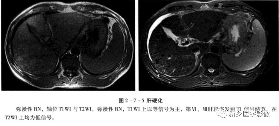 肝硬化磁共振影像表现 肝硬化磁共振影像表现